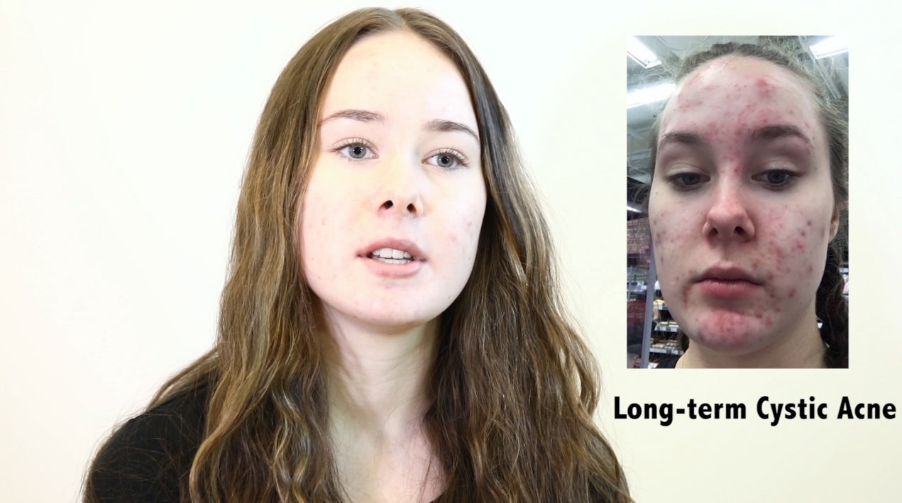 Beat Acne: The World's Most Common Skin Complaint!